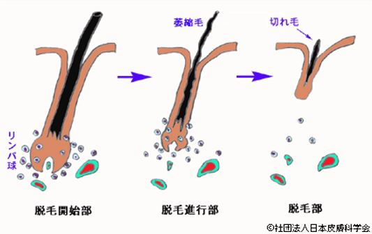 出典：https://www.dermatol.or.jp/qa/