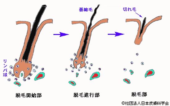 出典：https://www.dermatol.or.jp/qa/