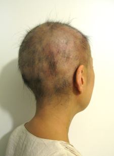 出典：http://alopecia945.blog.fc2.com/