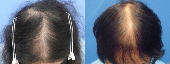 出典：http://www.hairmedical.com/