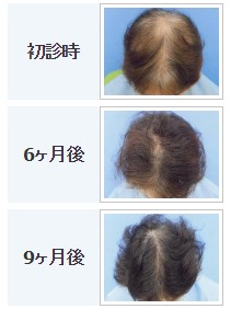 ※ヘアメディカル　62歳主婦の治療症例 出典：https://www.hairmedical.com/